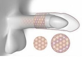 Aumento del pene en el volumen