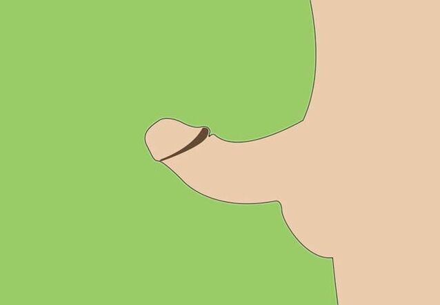 curvatura del pene como indicación de agrandamiento quirúrgico